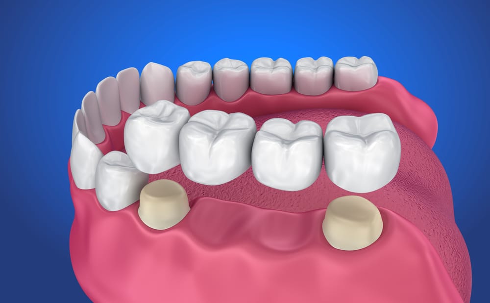 Mengenal Prosedur Dental Bridge untuk Merapikan Gigi Renggang