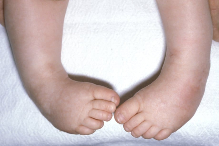 Kaki Bayi Bengkok Apa Penyebabnya Dan Bisakah Disembuhkan