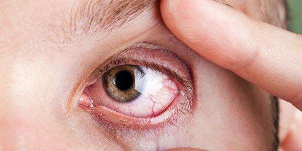 Simak Gejala Alergi Mata yang Perlu Anda Kenali