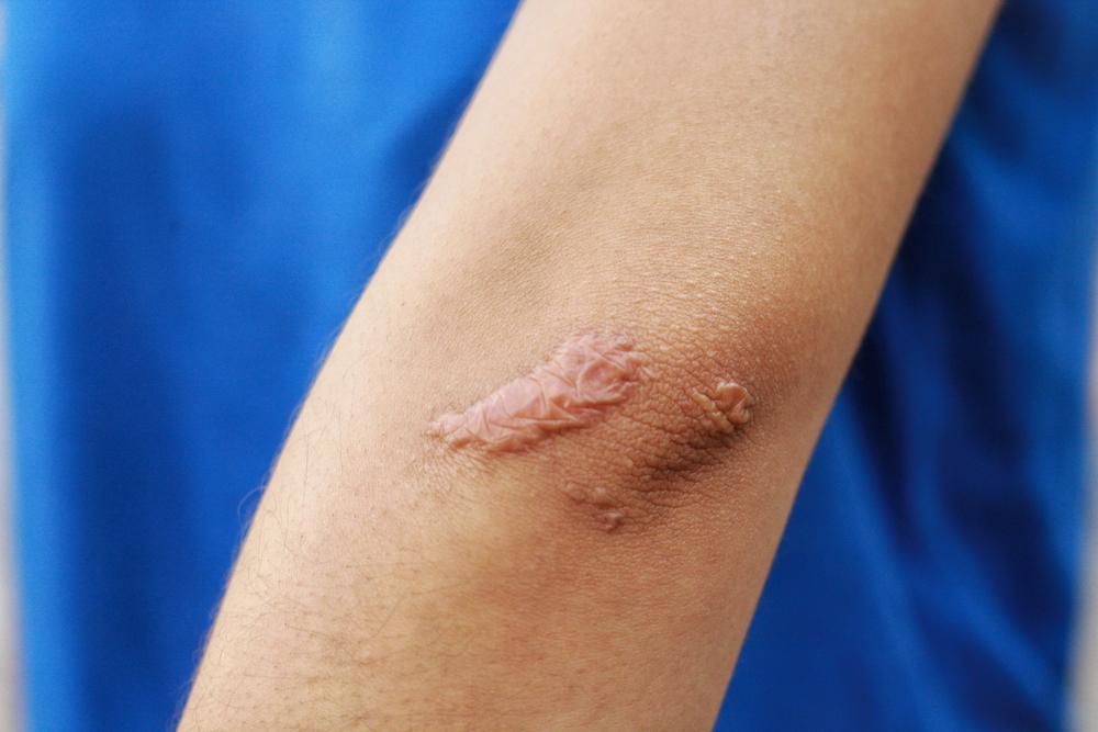 Cara Menghilangkan Bekas Eksim Secara Alami dan Medis