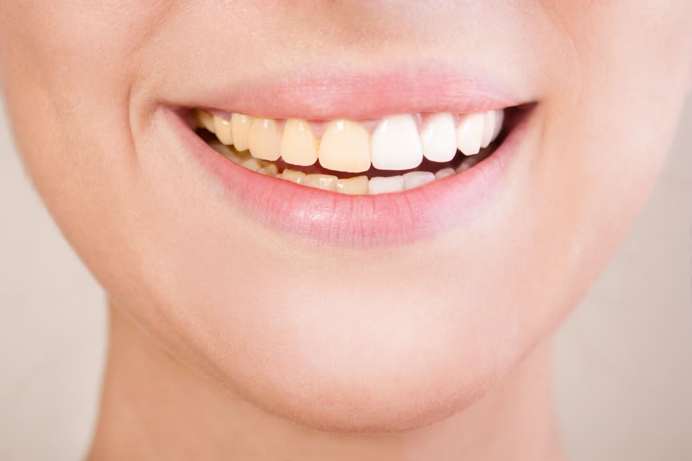 penggunaan sodium fluoride berlebihan sebabkan perubahan warna gigi
