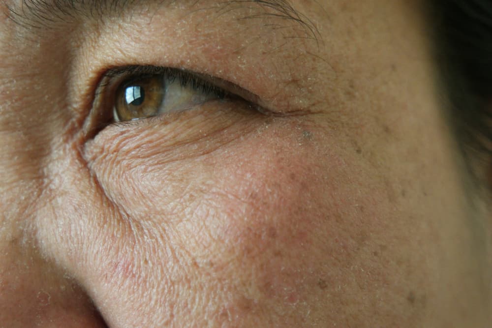 Muncul Freckles di Mata, Apakah Berbahaya? Perlukah Dihilangkan?