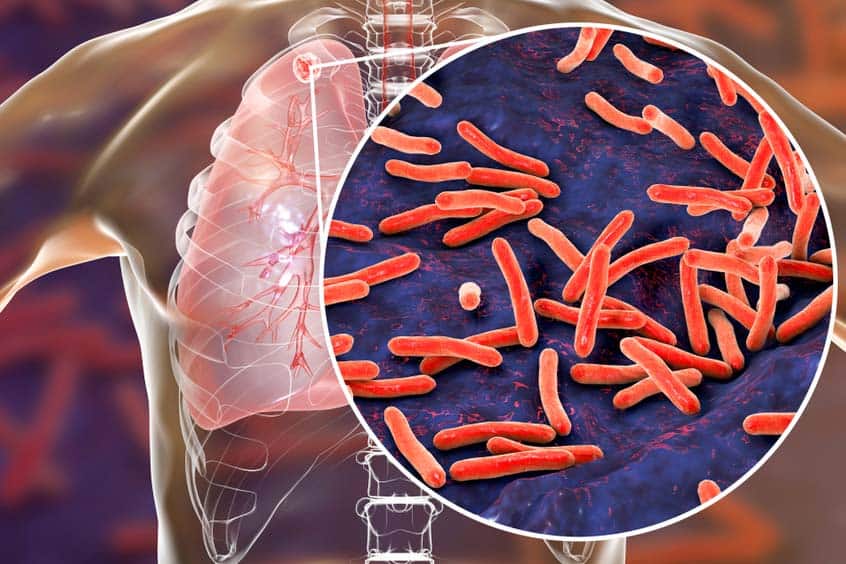 Mewaspadai TB Laten, Infeksi Bakteri TB Tanpa Gejala