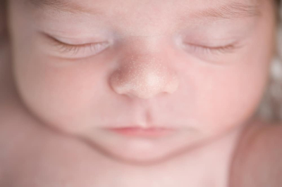  Bercak  Putih  Pada  Kulit  Bayi Penyebab  Ciri dan Cara 
