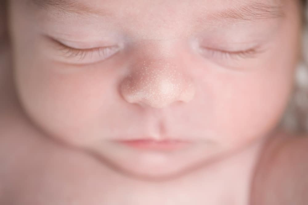 Melihat Bintik Putih Pada Bayi? Tidak Perlu Khawatir, Itu Adalah Milia