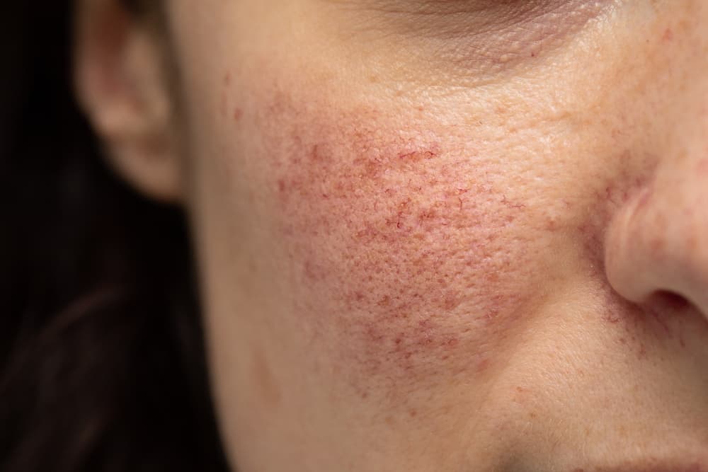 Sama-Sama Merah di Kulit, Apa Perbedaan Rosacea dan Jerawat?