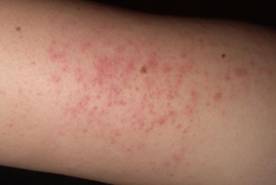 keratosis-pilaris