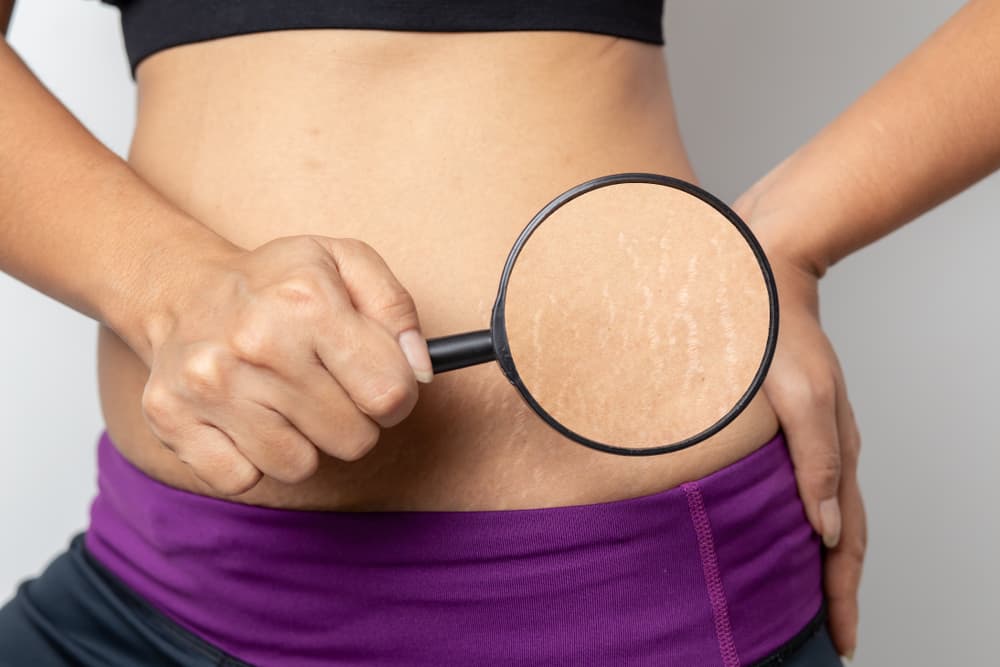 Menyamarkan Garis Stretch Mark dengan Lidah Buaya Plus Cara Mengolahnya