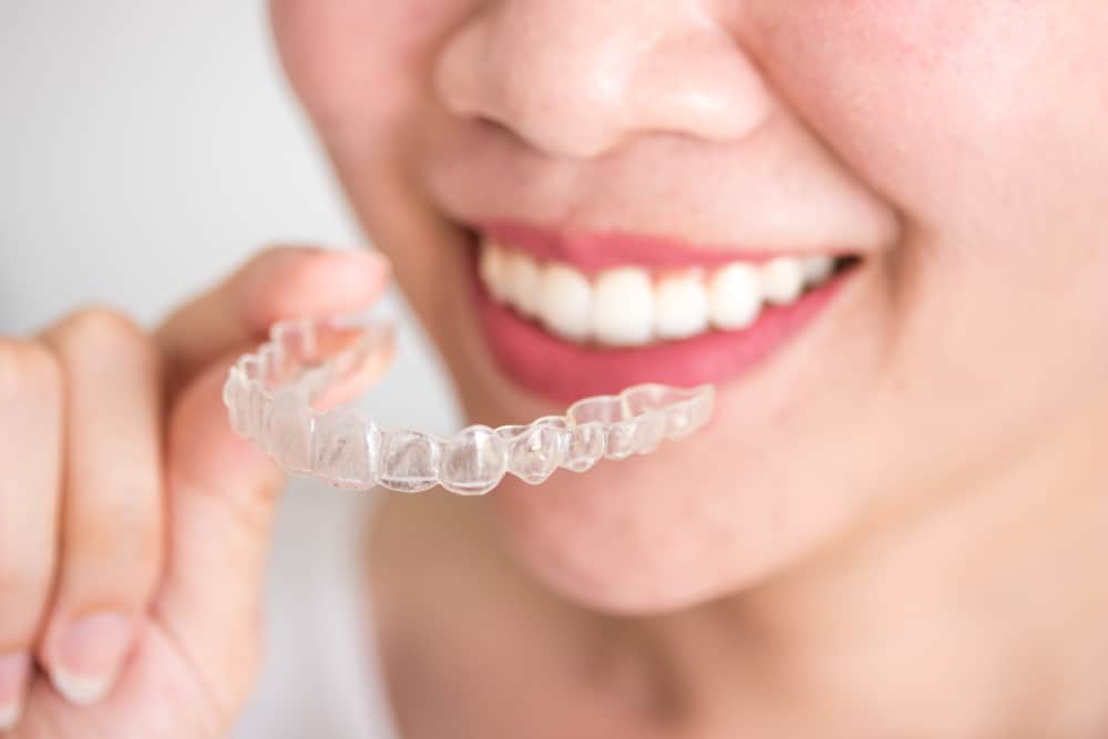 Plus-Minus Pemakaian Behel Transparan untuk Merapikan Gigi