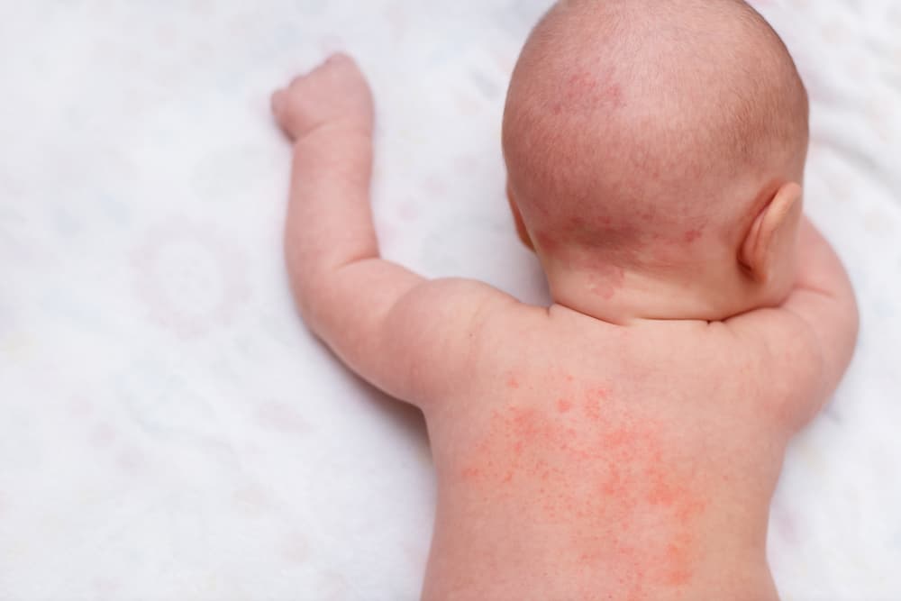 Biang Keringat pada Bayi: Penyebab, Ciri-Ciri, Cara Mengatasi, dan Tips Mencegahnya