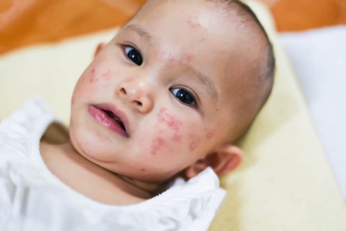 penyakit kulit pada bayi