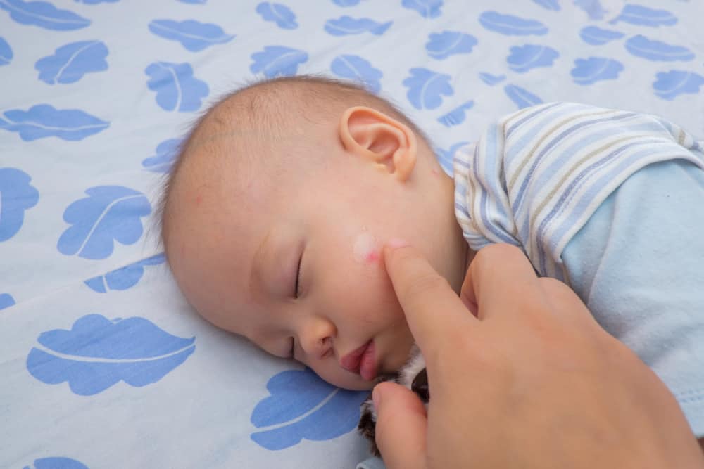 bentol berair pada kulit bayi