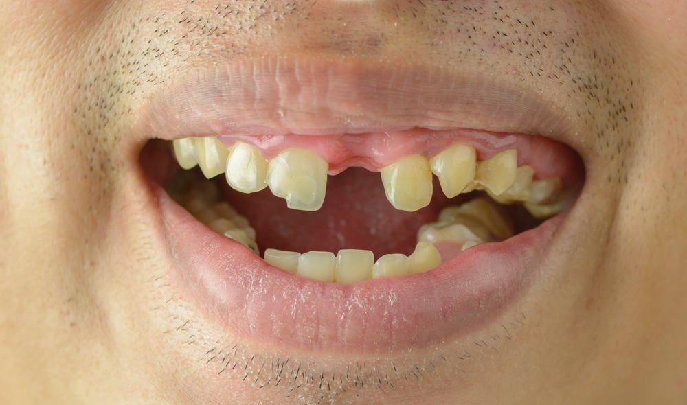 Mengenal Hypodontia, Kelainan Genetik Saat Sejumlah Gigi Tak Tumbuh