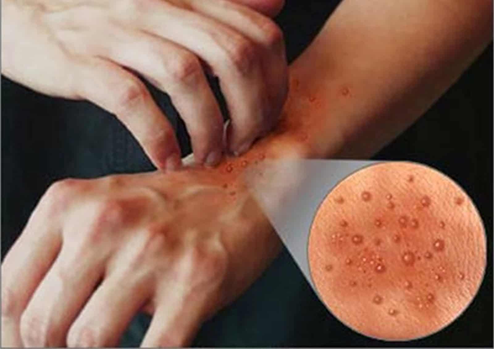 Penyebab Dermatitis Beserta Pemicunya di Lingkungan Sekitar