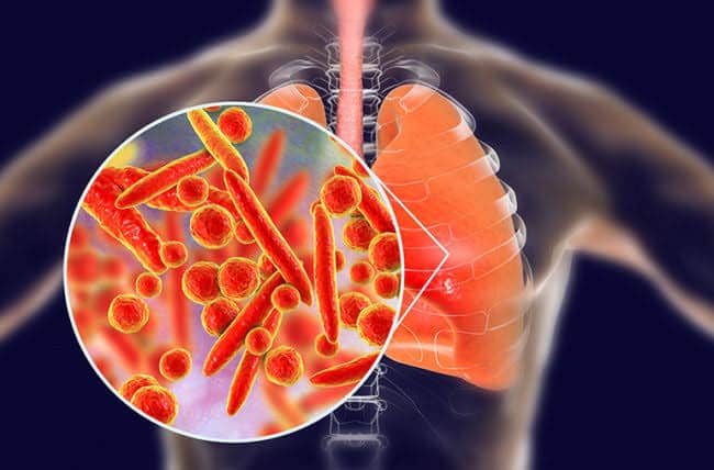 Yang ringan infeksi virus kematian sistem berat paru-paru menyebabkan hingga menyerang yang pernapasan gangguan Virus Corona