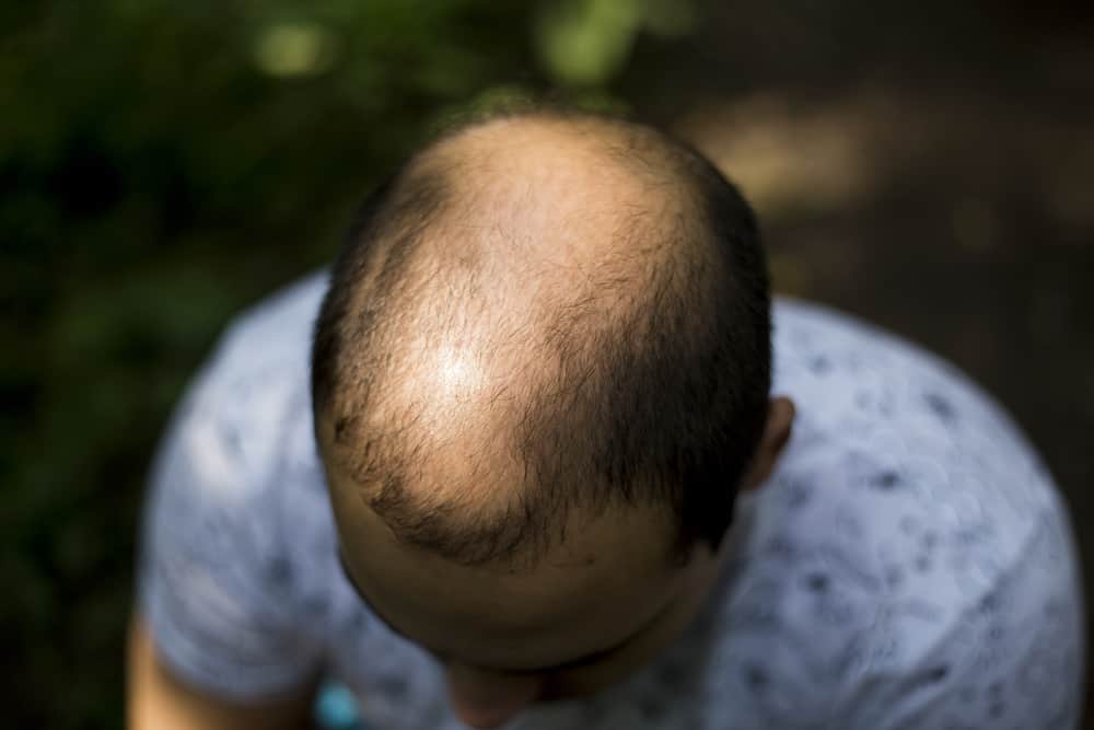 Cara Mencegah Pattern Baldness, Kebotakan yang Umum Terjadi Pada Pria