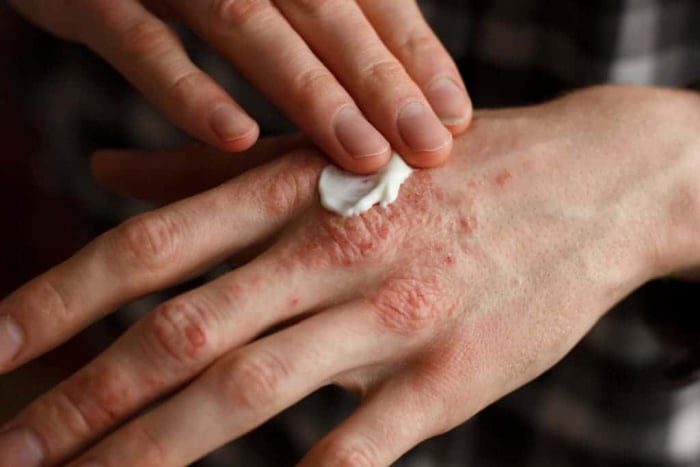 Eksim Dermatitis Atopik Gejala Penyebab Dan Pengobatan