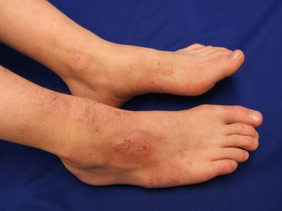 Dermatitis statis penyebab sela sela jari kaki gatal