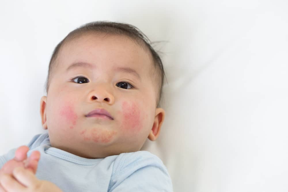 Penyebab Dermatitis pada Bayi dan Gejala yang Paling Umum Muncul