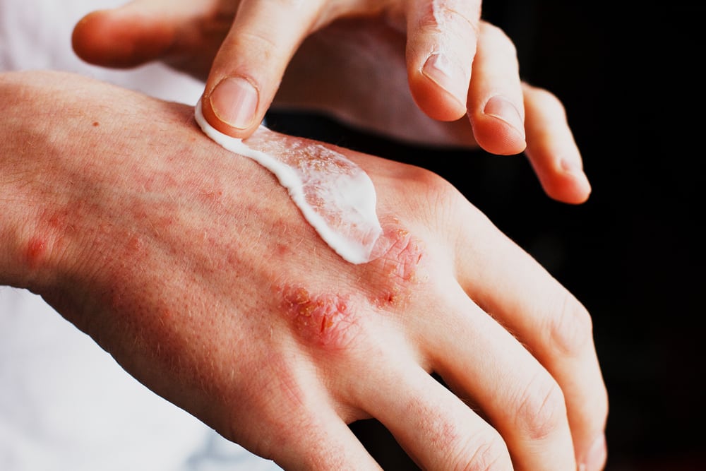 6 Pilihan Salep Psoriasis yang Ampuh untuk Redakan Gejala