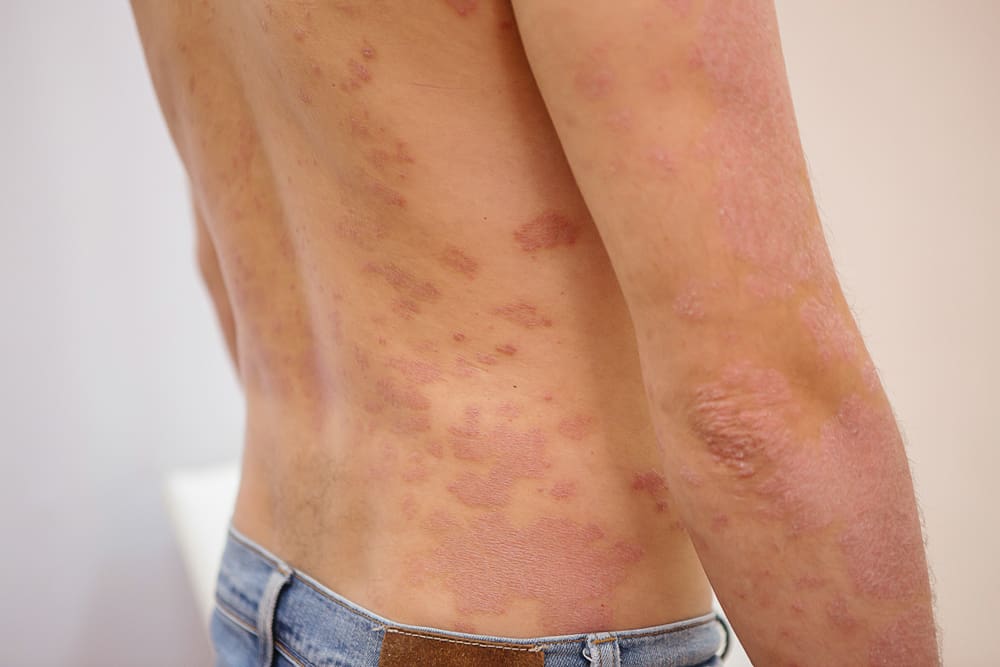 Psoriasis Eritroderma (Psoriasis Eritrodermik)