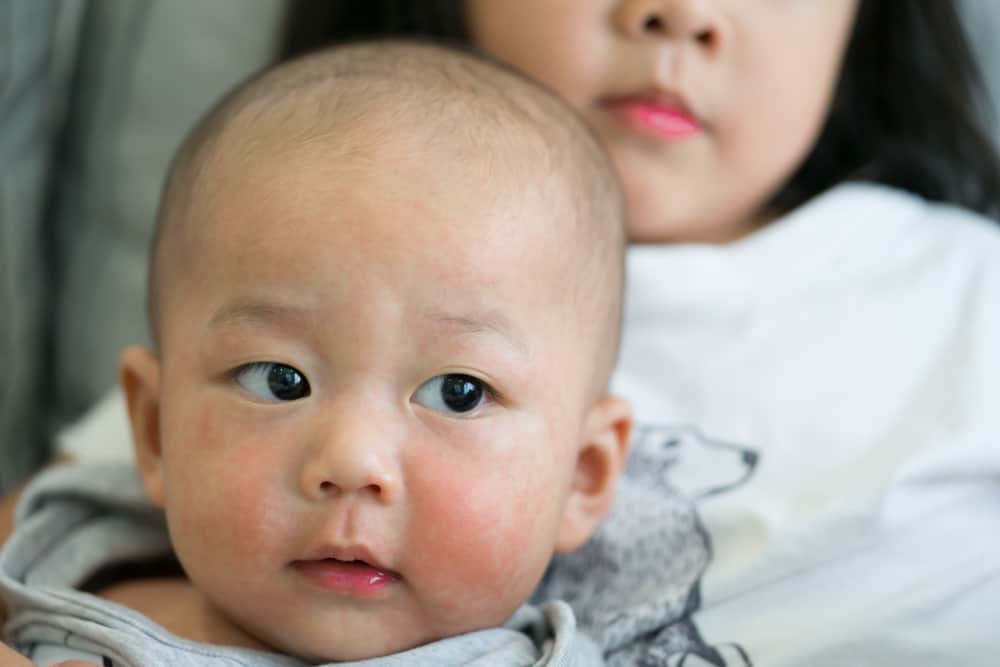 obat tradisional ruam di pipi wajah bayi