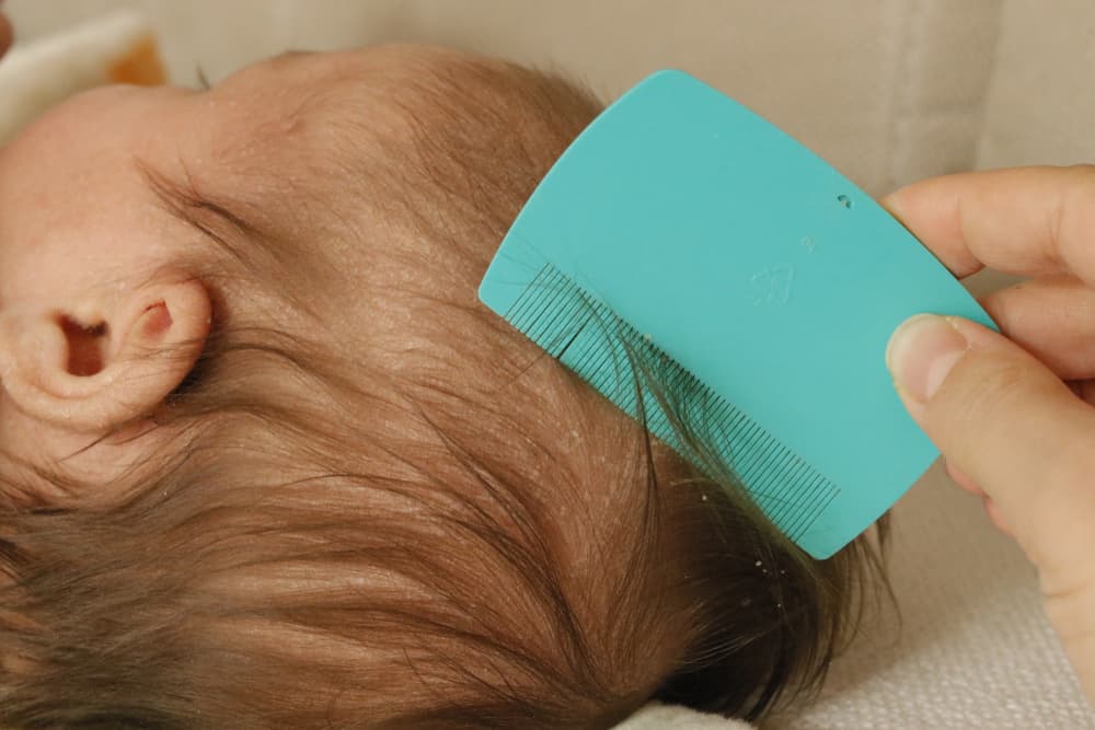 cara menghilangkan kerak di kepala bayi
