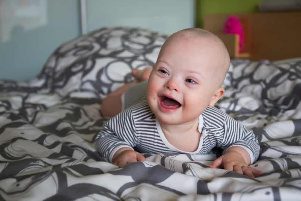 Ciri-Ciri Down Syndrome pada Bayi dan Anak yang Perlu Diwaspadai