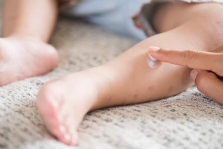 5 Obat Cacar Air di Apotek dan Perawatan Rumahannya