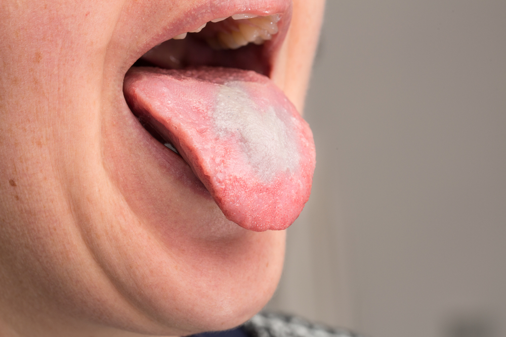 10 Obat Tradisional untuk Menangani Infeksi Jamur Mulut (Oral Thrush)