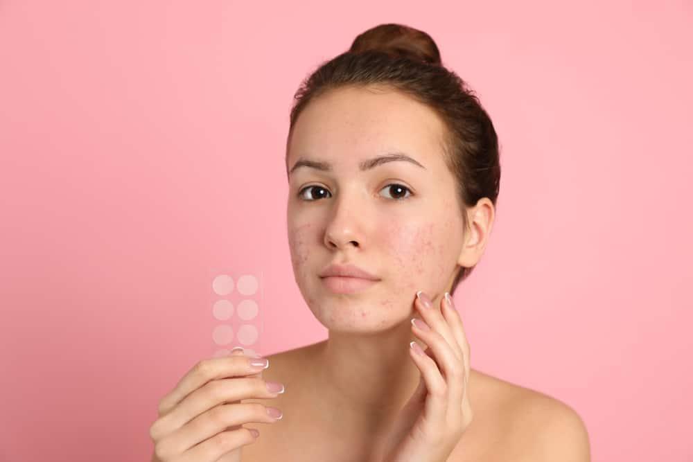 Cara Pakai Acne Patch yang Benar agar Jerawat Cepat Sembuh