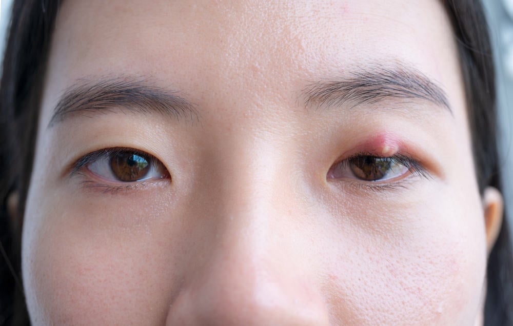 7 Cara Menghilangkan Benjolan di Kelopak Mata (Kalazion)