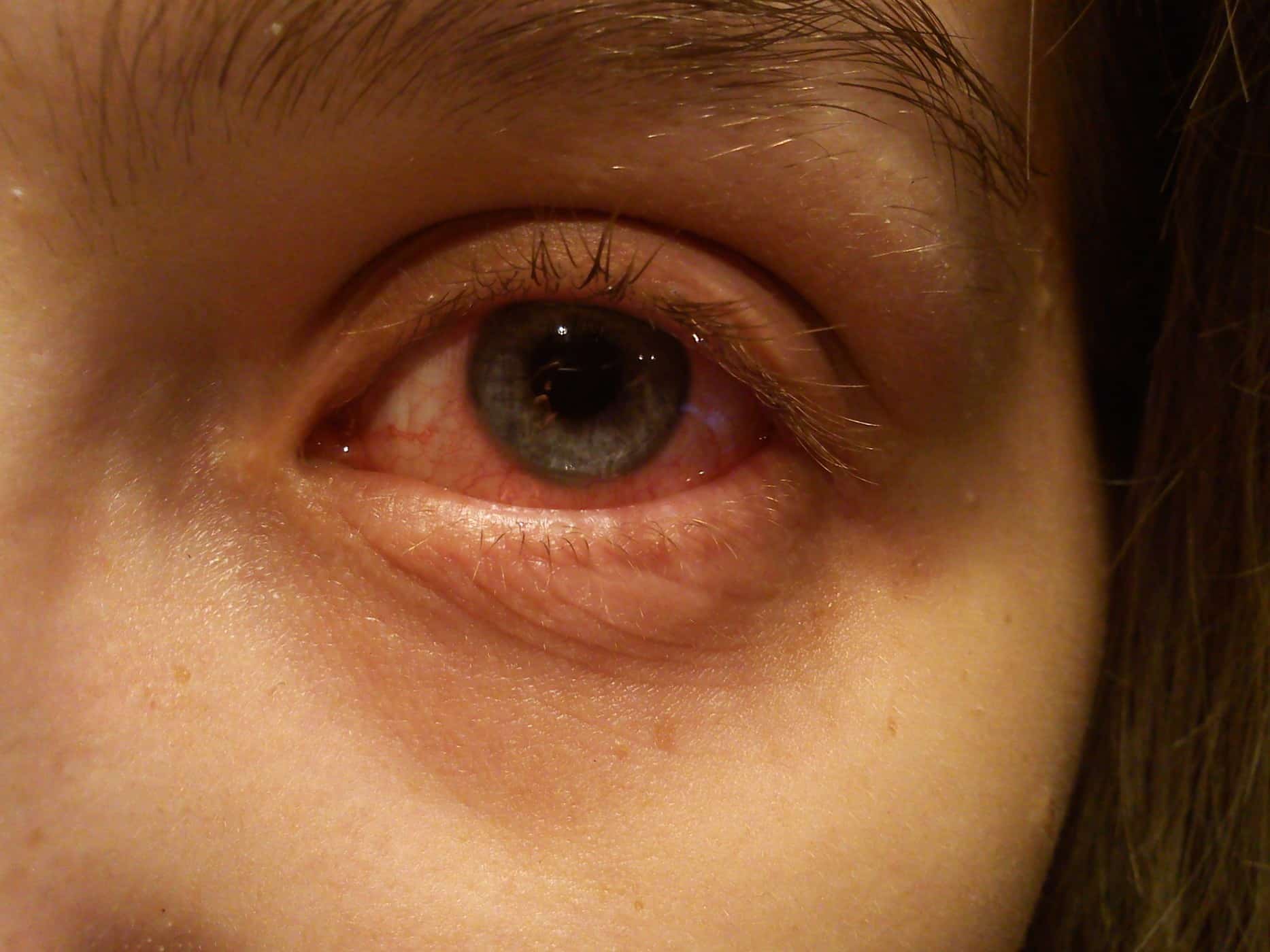 Mata Merah dan Berair: Gejala Coronavirus COVID-19 yang Jarang Diketahui
