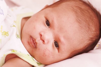 penyebab bentol merah pada kulit bayi