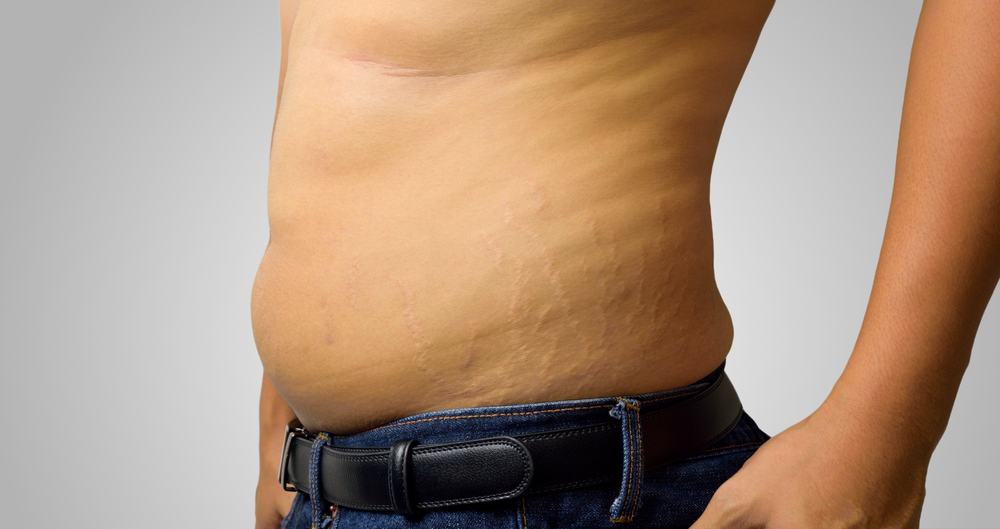 Bagaimana Stretch Mark pada Pria Bisa Muncul dan Apa Penyebabnya?