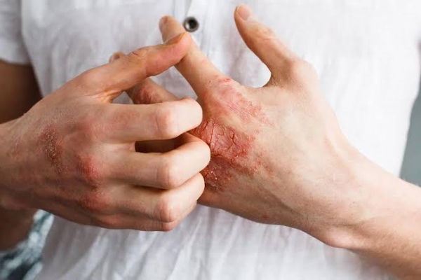 9. Perbedaan Dermatitis Herpetiformis dengan Penyakit Kulit Lainnya