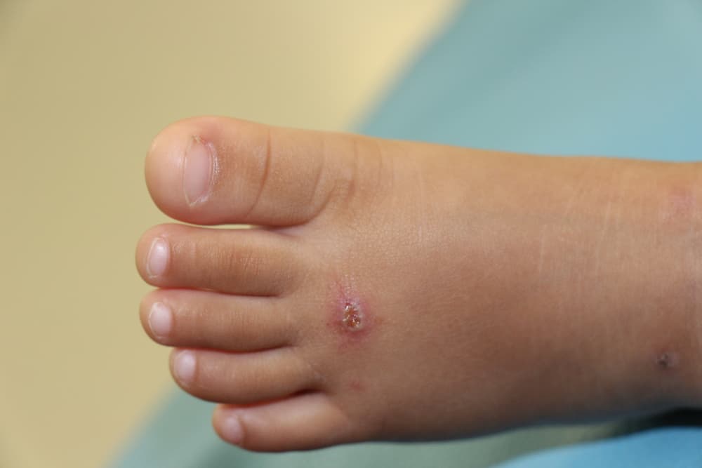 Mungkinkah COVID Toes atau Lesi pada Kaki Jadi Gejala Baru Coronavirus?