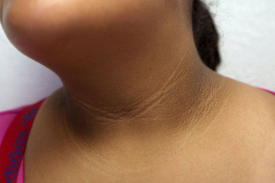 acanthosis nigricans