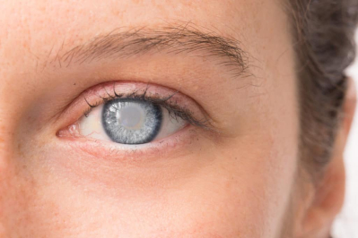 penyakit mata pada psoriasis