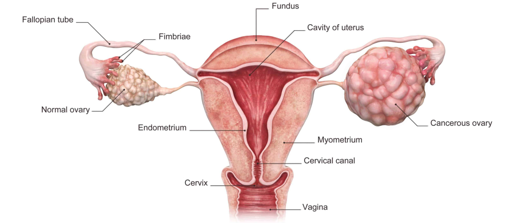 gejala ciri-ciri kanker ovarium
