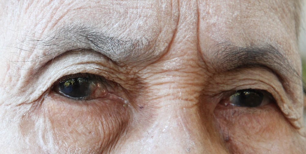 Salah satu gejala katarak adalah penglihatan buram dan berkabut.