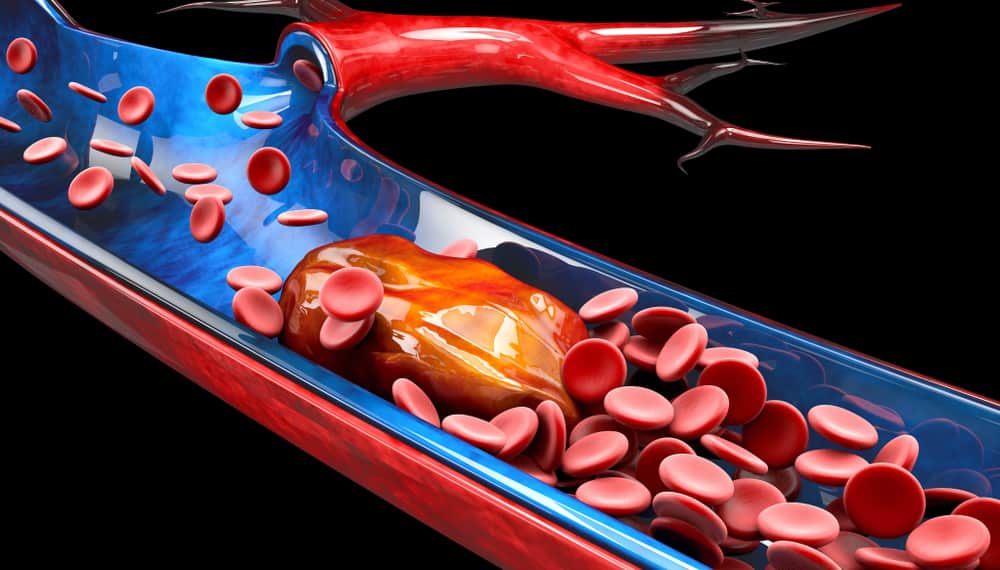 Trombosis Arteri