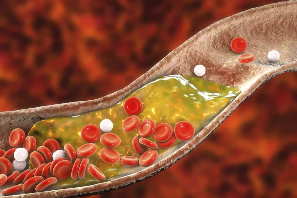 Mengenal Trombosis, Gangguan Pembekuan Darah yang Bisa Berakibat Fatal
