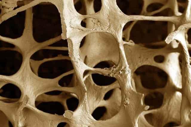11 Faktor Penyebab Osteoporosis, Bukan Cuma Usia