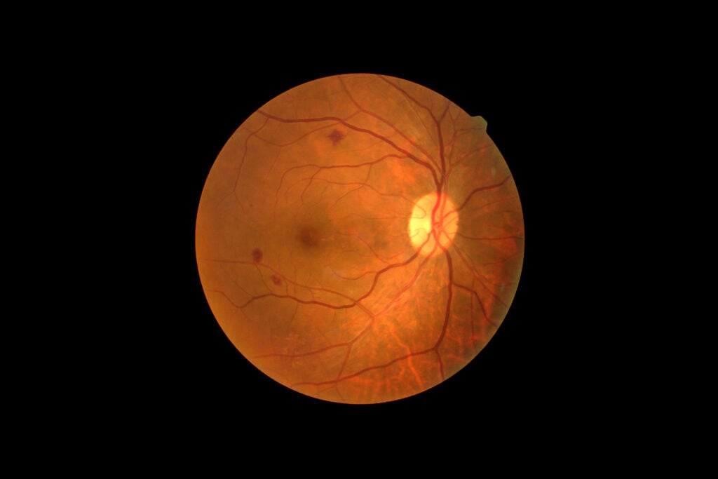 diabetic retinopathy atau retinopati diabetik
