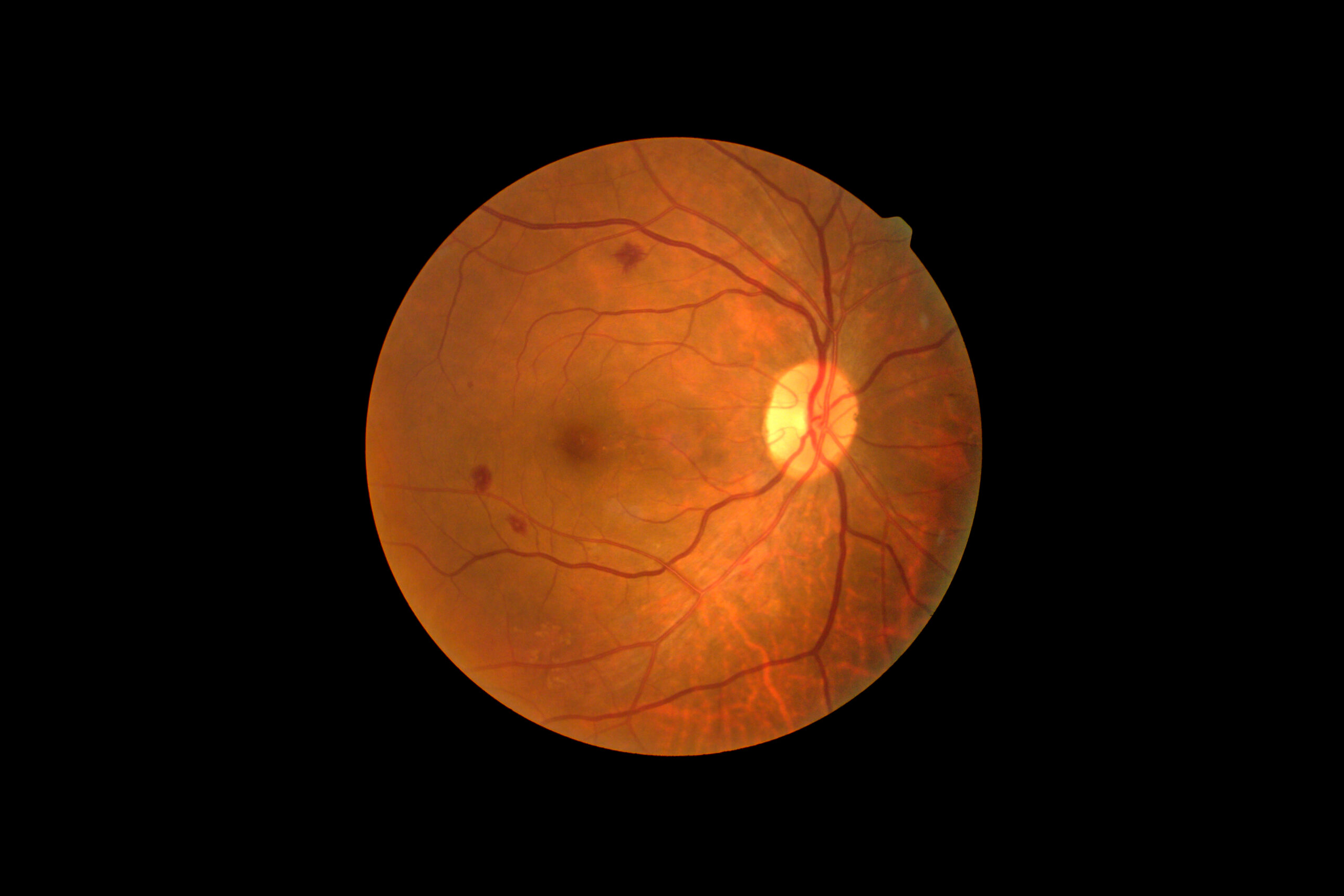 retinopati-diabetik