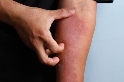 gambar kulit dermatitis adalah, penyebab dermatitis kontak