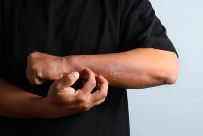 Penyebab eksim atau dermatitis atopik