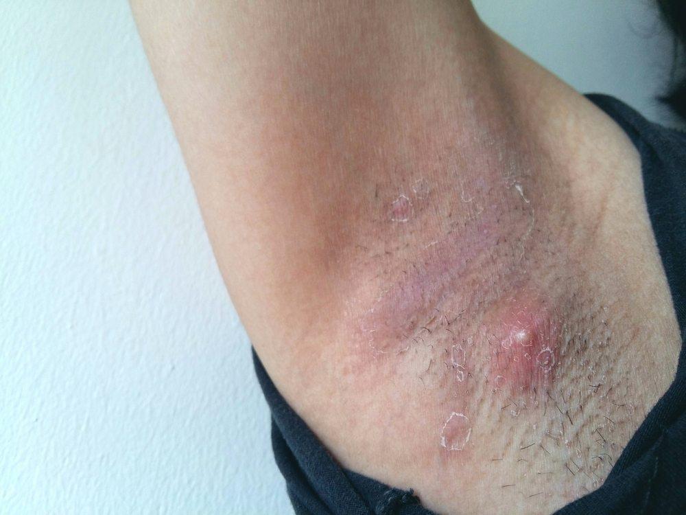 Ada Jerawat di Ketiak? Simak Penyebab dan Cara Mengobatinya