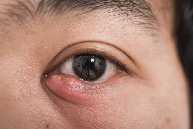 Mengenal Bintitan, Benjolan Kecil di Kelopak Mata Akibat Infeksi